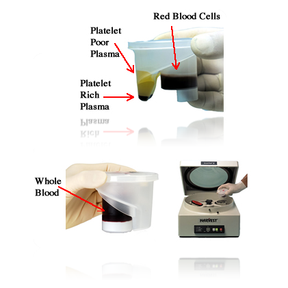 how-is-prp-made-img how-is-prp-made-img